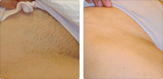 TIRAS Depilación Corporal caja x 20 unidades